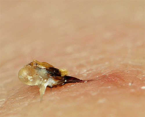 Sengatan lebah dengan sebahagian daripada organ dalamannya, tertinggal dalam kulit manusia