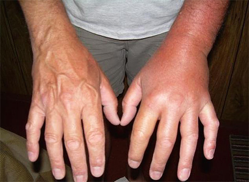Στη φωτογραφία - ένα χέρι πρησμένο μετά από δάγκωμα σφήκας