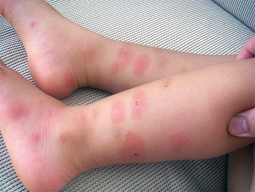 È difficile per i bambini resistere a graffiare i morsi, il che significa che queste ferite sono una porta aperta per le infezioni.
