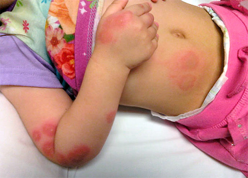 Ugrizi stjenica kod djece posebno su opasni i mogu imati dugoročne posljedice.