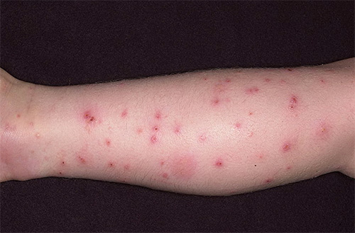 I morsi delle pulci possono causare reazioni allergiche e dermatiti
