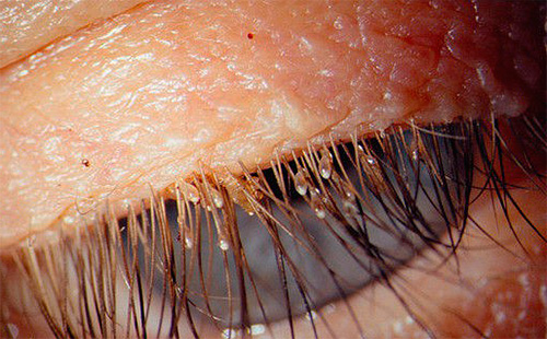 Blygdlöss kan infektera en persons ögonfransar och ögonbryn.