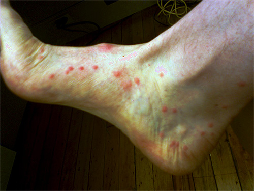 Při kousnutí blecha vstříkne pod kůži výměšky speciálních žláz, které způsobují primární alergickou reakci.
