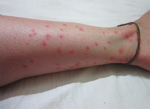 Vlooienbeten kunnen niet alleen een allergische reactie veroorzaken, maar ook zeer ernstige ziekten.