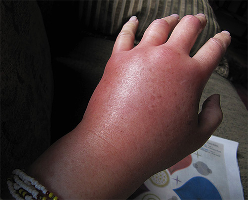 Le tossine nel veleno di calabrone possono causare una grave reazione allergica