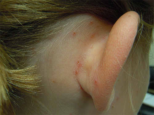 De foto toont gekamde luizenbeten achter de oren van een kind