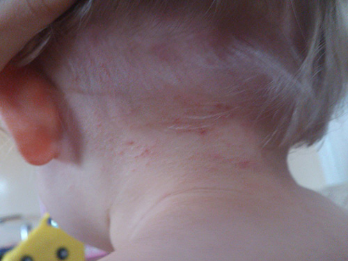 De rode stippen zijn duidelijk zichtbaar op de foto - plaatsen van luizenbeten in de nek van het kind