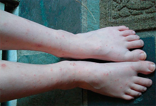 La foto mostra le gambe morsicate dalle pulci domestiche.