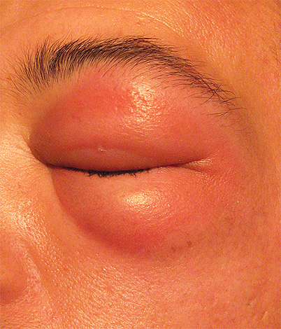 Bilden visar konsekvenserna av ett bålgetingsbett i ögonlocket