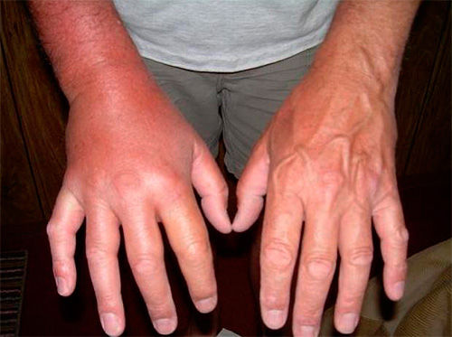 La foto mostra il gonfiore della mano dopo una puntura di vespa.
