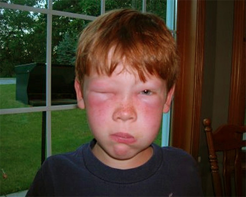 Dacă înțepătura de viespe a căzut pe fața sau pe gâtul copilului, atunci reacția poate fi mai pronunțată decât în ​​cazul lezării brațelor sau picioarelor