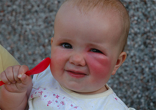 Egy kisgyermek harapásának kezelésére használhatja a Gardex Baby balzsamot.