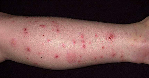 Vết cắn của bọ chét không chỉ gây đau đớn mà còn thường dẫn đến hình thành mụn mủ trên da.