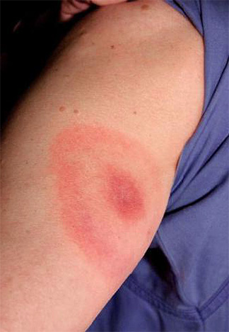 Direkt efter ett insektsangrepp kan man också försöka suga ut giftet ur såret.