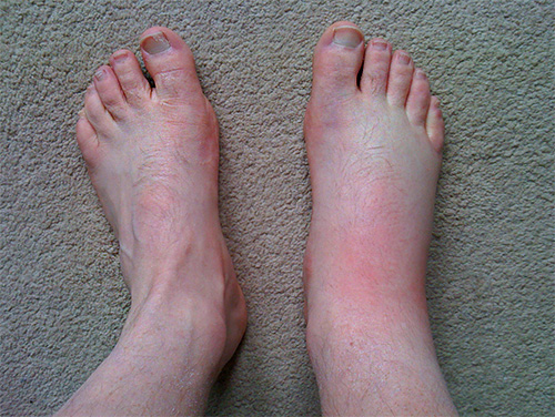 Om en stickande insekt har bitit till exempel i foten kan svullnaden sprida sig till hela benet