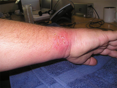 Dacă pieptănați constant locul înțepăturii viespii, atunci există o probabilitate mare de a introduce o infecție în rană.