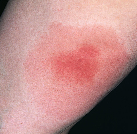 Inflammation på platsen för ett getingstick