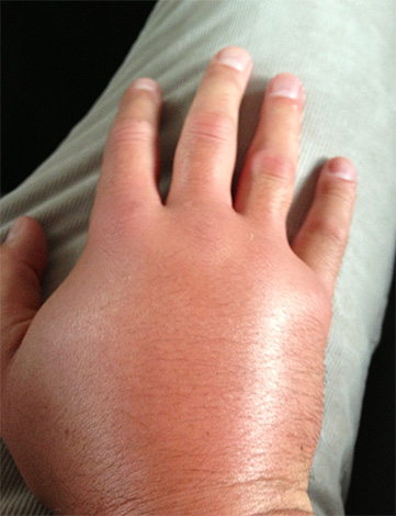 După un atac al unui gigant asiatic, s-a format o umflare severă a mâinii