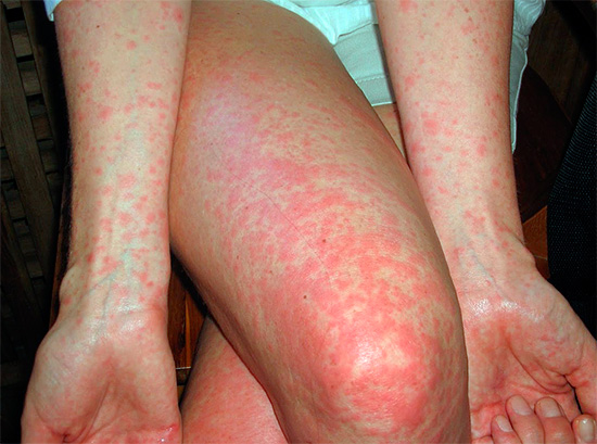 Alergie na kousnutí hmyzem se také může projevit ve formě malé vyrážky po celém těle nebo v oddělených oblastech.