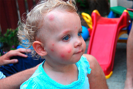Sporen van insectenbeten op het gezicht van een kind