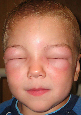 Jika kanak-kanak mengalami reaksi alergi yang teruk, dapatkan rawatan perubatan segera.