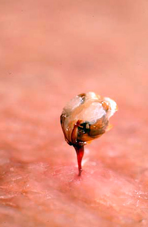 Fotografija prikazuje žaoku pčele koju je insekt ostavio u ljudskoj koži.