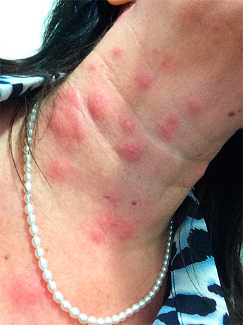 De foto toont enorme bedwantsbeten in de nek van een vrouw.
