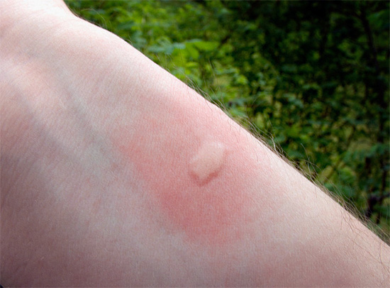 Đây là vết muỗi đốt mới