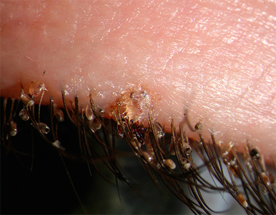 Bức ảnh này cho thấy rõ ràng rận mu và trứng chấy trên lông mi của một người.