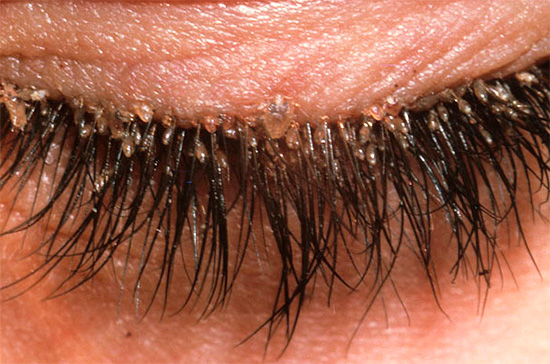 Một ví dụ khác về lông mi bị nhiễm chấy rận.