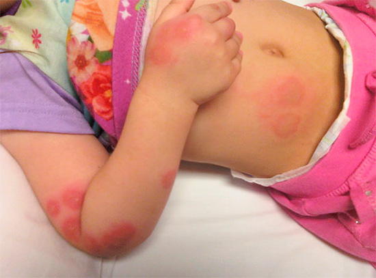 Foto ini menunjukkan kesan gigitan pepijat katil pada kanak-kanak.