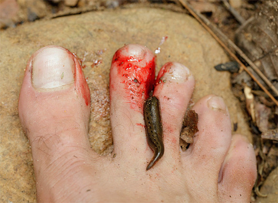 Một con đỉa bị dính vào ngón chân của một người đàn ông.