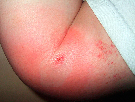 Thường ở trung tâm vết cắn của nhiều loại côn trùng, bạn có thể thấy dấu vết của vết thủng trên da.