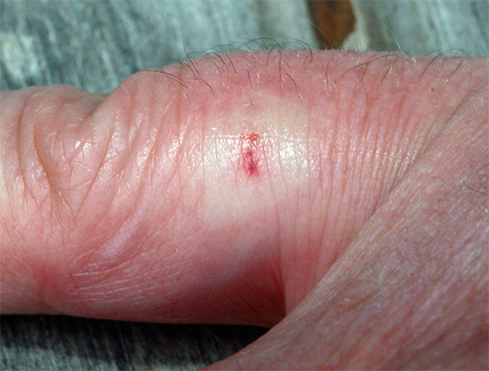 Apabila tebuan menyerang, sedikit bengkak serta-merta berkembang di kawasan yang terjejas, dan pendarahan subkutaneus sering diperhatikan.