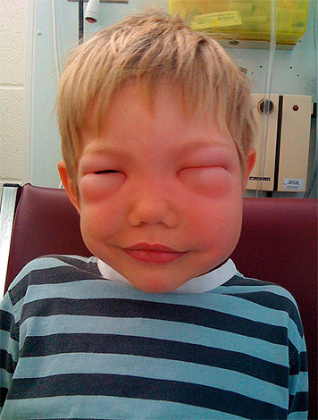 Néhány ember nagyon erős allergiás reakciót vált ki a darazsak és a darazsak harapására, ami néha veszélyt jelent az emberi egészségre és életre.