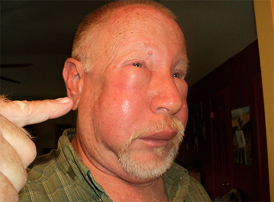 Umflarea feței după o mușcătură de hornet