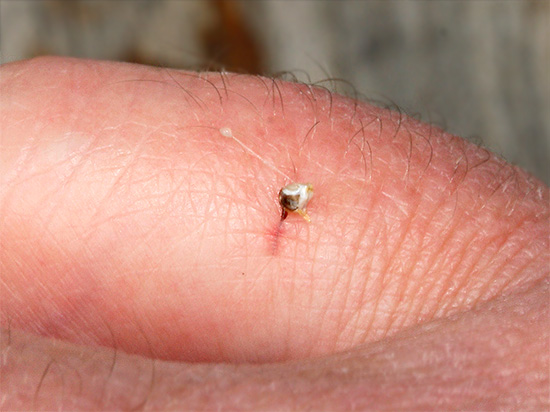 Dacă, după o mușcătură de insectă, o înțepătură iese în rană, atunci a fost o albină.