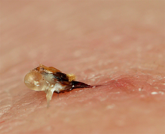 Méhcsípés az emberi bőrben.