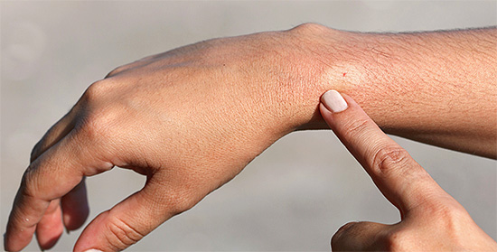 Στο σημείο ενός φρέσκου δαγκώματος, εμφανίζεται αρχικά ένα ελαφρύ πρήξιμο, πιο ανοιχτό από το περιβάλλον δέρμα.