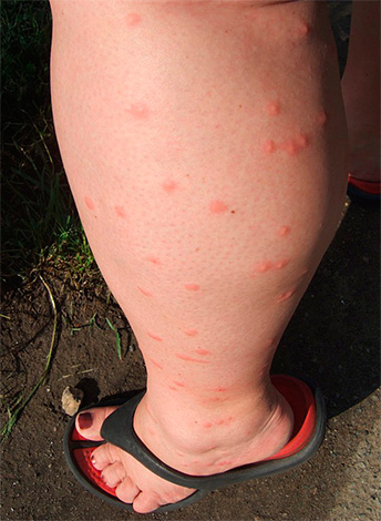 Male crvene točkice na nozi - brojni ugrizi buha.