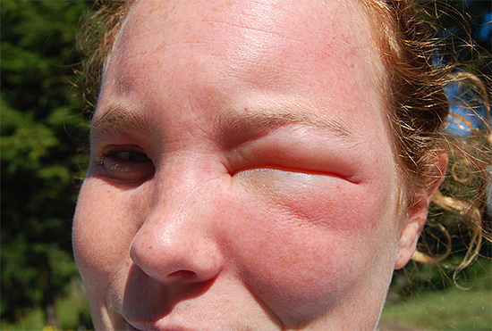 Sengatan tawon di muka selalunya membawa kepada edema yang sangat ketara, dan kedua-dua mata boleh menutup sekaligus.