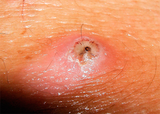 Oko pješčane buhe, koja je prodrla pod kožu, obično se razvija teška upala i gnojenje, sve do gangrene.