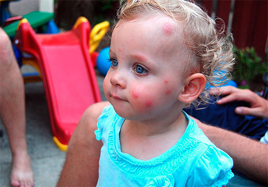 Kleine kinderen kunnen soms zeer scherp reageren, zelfs op de beten van gewone muggen.