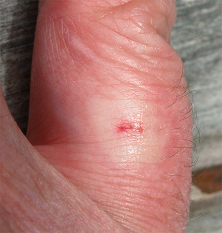 Τσίμπημα σφήκας στο δάχτυλο