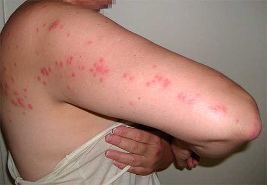 종종 빈대에 물린 경우 희생자의 피부에 있는 붉은 점의 특징적인 사슬(경로)로 식별할 수 있습니다.