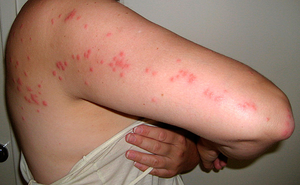 Vết cắn của rệp giường thường tạo thành một vết đặc trưng trên da của nạn nhân.