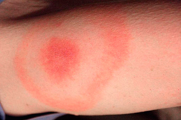 진드기에 물린 부위 주변의 동심원 빨간색 원은 라임 보렐리아증 감염을 나타냅니다.