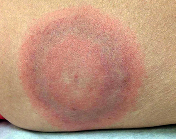 Taková skvrna (prstencový erytém) je prvním příznakem infekce lymskou boreliózou.