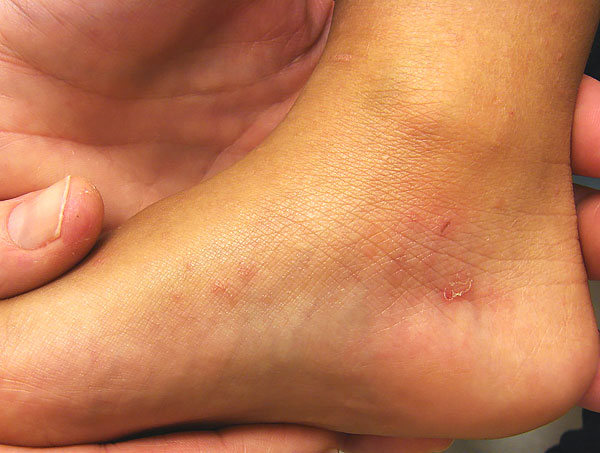 A bőr viszkető járatainak jellegzetes hálózata - ezeken a helyeken a láb nagyon viszket.