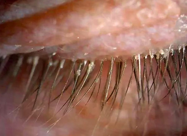 Ett karakteristiskt symptom på demodikos är flytningar på ögonfransarna.